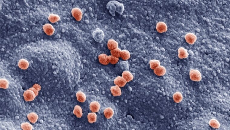 Nachkolorierte elektronenmikroskopische Aufnahme von SARS-CoV-2 Viren auf einer Lungenzelle