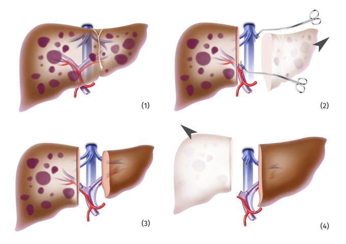 Two-step transplantation: If, for example, the entire liver is affected by metastases (1), first the left-sided liver lobe is removed (2) and replaced with the healthy partial organ from a living donor. The reduced blood flow to the remaining part of the liver stimulates graft growing (3) until after about 2 weeks it adopts complete organ function and the remaining diseased part is removed (4).